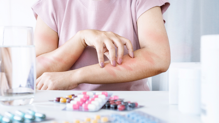 Allergic Reaction to CBD