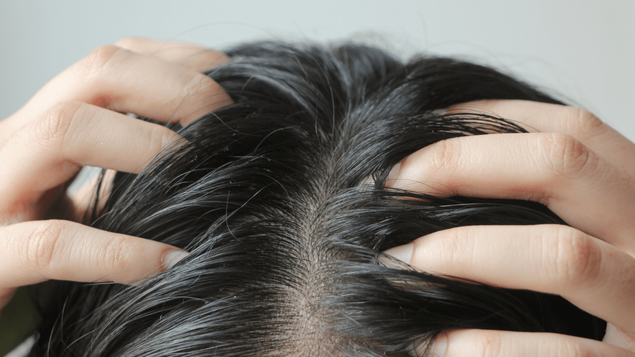 CBD for Dry Scalp. What Are the Benefits?